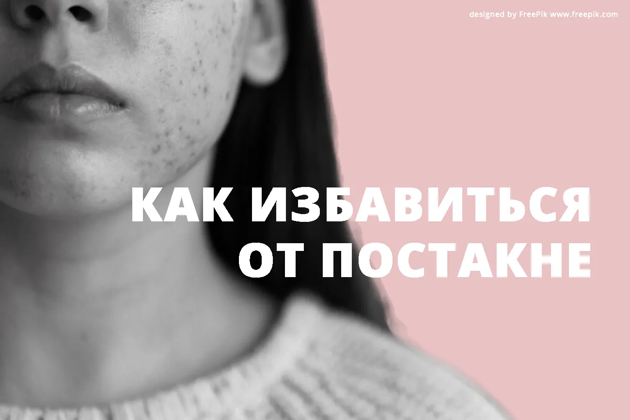 Как избавиться от постакне