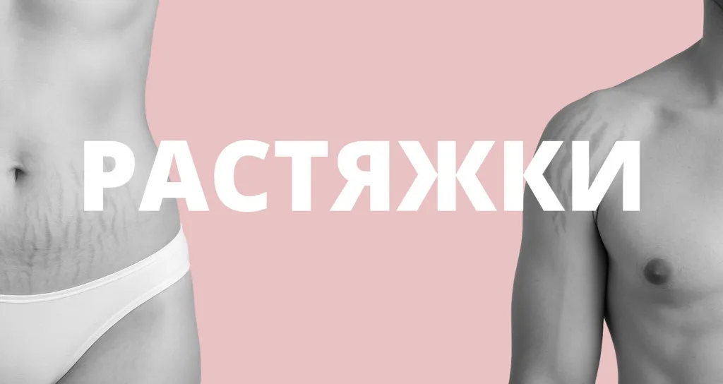 Как избавиться от растяжек