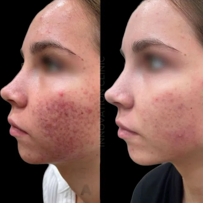 Комплексное лечение акне фото до и после 15