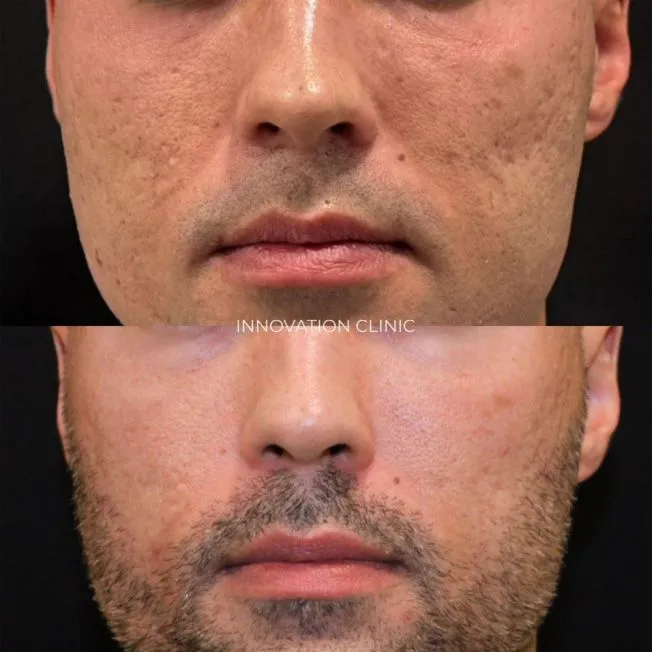 Лазерная шлифовка рубцов от акне фото до и после