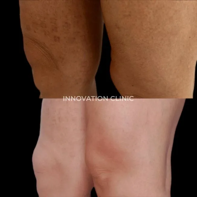 Малоинвазивный RF-лифтинг фото до и после 1