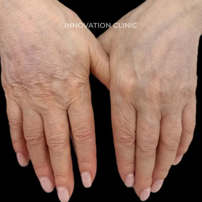 Монополярный RF-лифтинг Volnewmer фото до и после 7