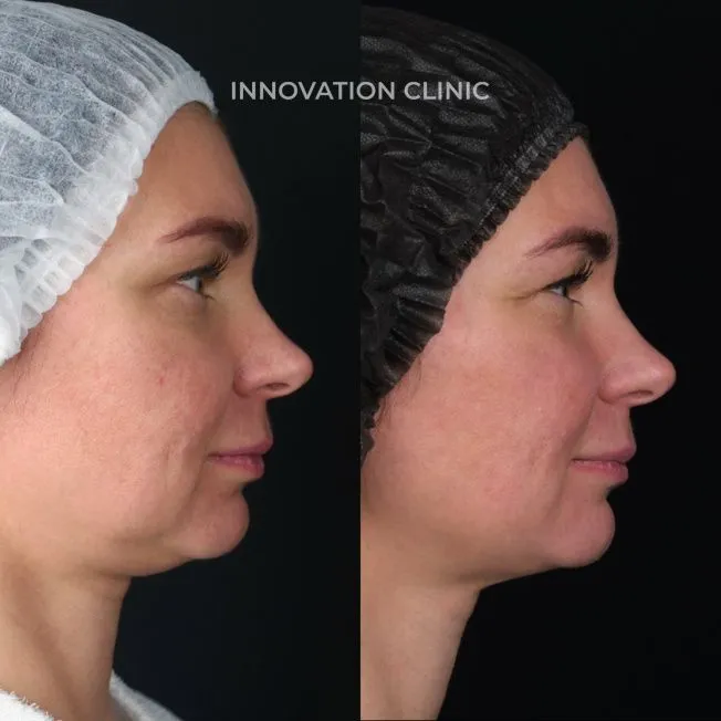 Монополярный RF-лифтинг Volnewmer фото до и после 1