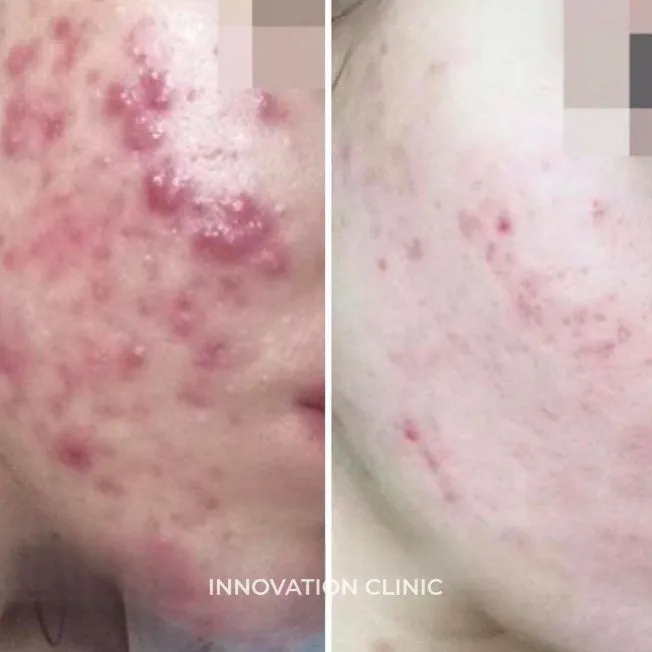 Комплексное лечение акне фото до и после 4