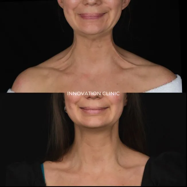 Устранение платизмарных тяжей фото до и спустя 14 дней