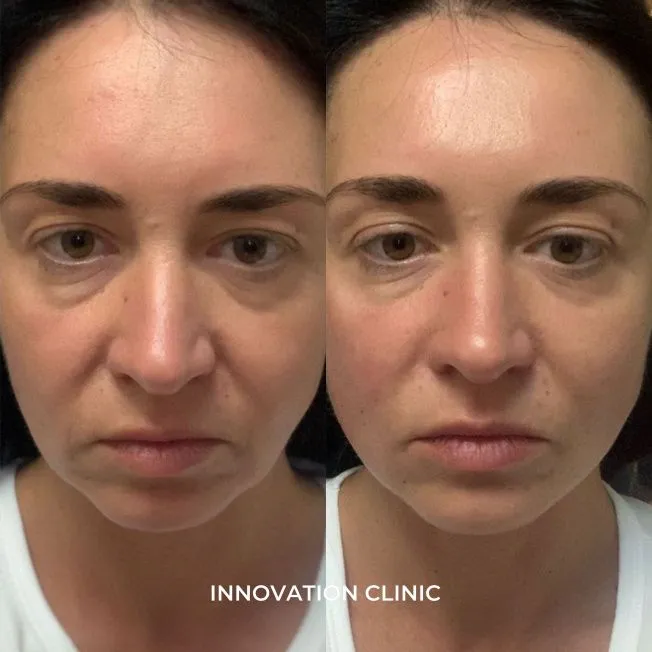 Деликатная гармонизация лица филлером фото до и после