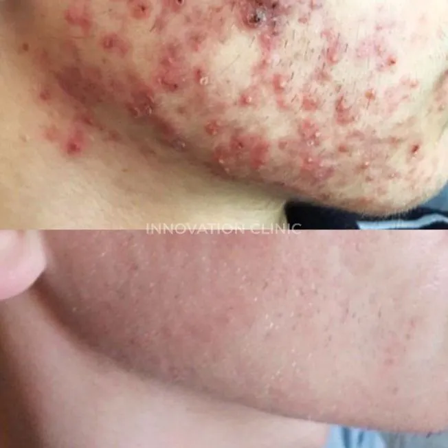 Комплексное лечение акне фото до и после 23