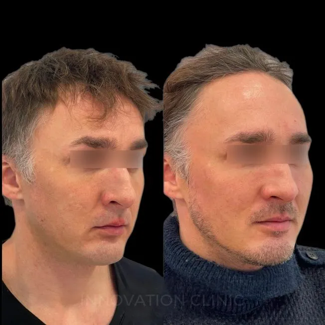 Нитевой лифтинг лица фото до и после 12