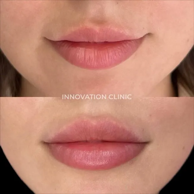 Коррекция формы губ филлером фото до и после 6