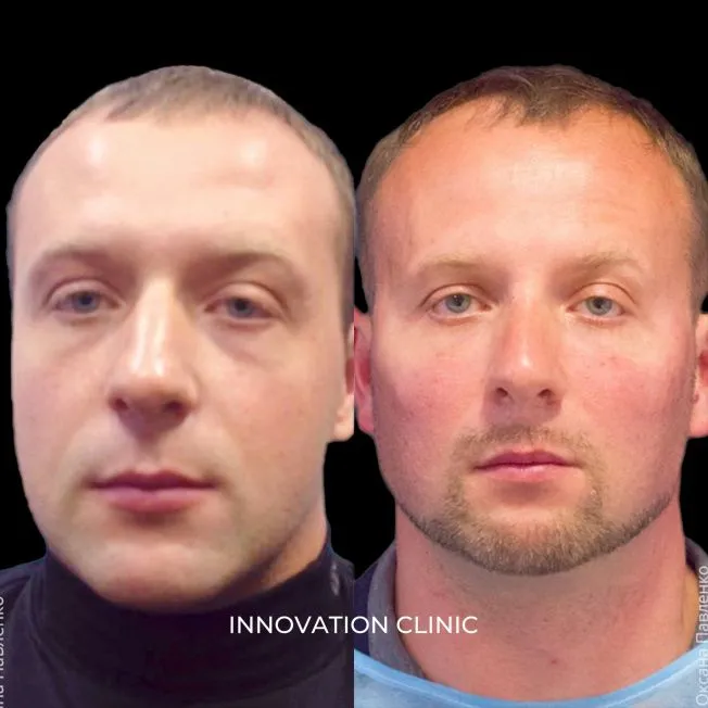 FullFace-коррекция лица филлерами фото до и после 6