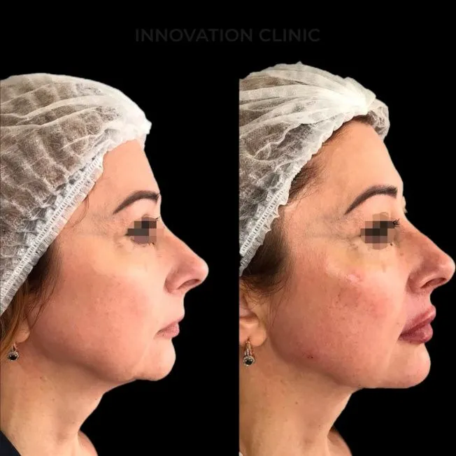 FullFace-коррекция лица филлерами фото до и после 1