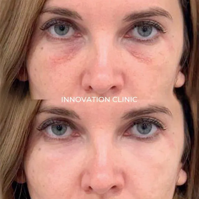 Коррекция носослёзной борозды фото до и после 13