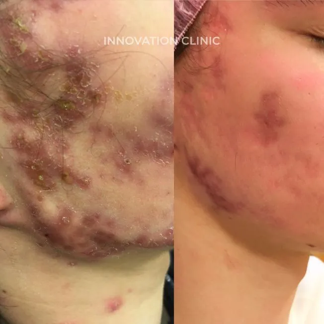 Комплексное лечение акне фото до и после 20