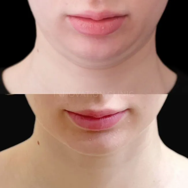 Малоинвазивный RF-лифтинг фото до и после 4