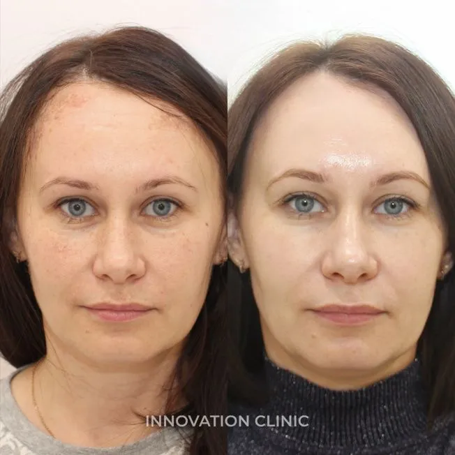 Сочетанный протокол фототерапия BBL фото до и после 1