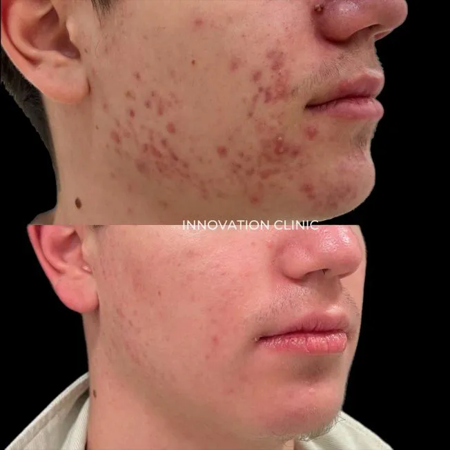 Комплексное лечение акне фото до и после 26