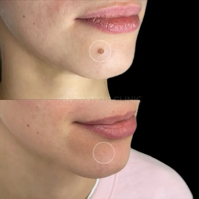 Удаление доброкачественного новообразования фото до и после 3