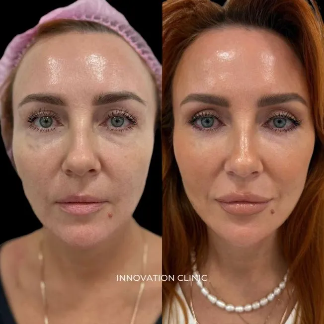Деликатная FullFace-коррекция лица фото до и после 4