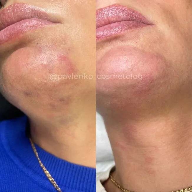 Лечение сосудистой эмболии фото до и после 3