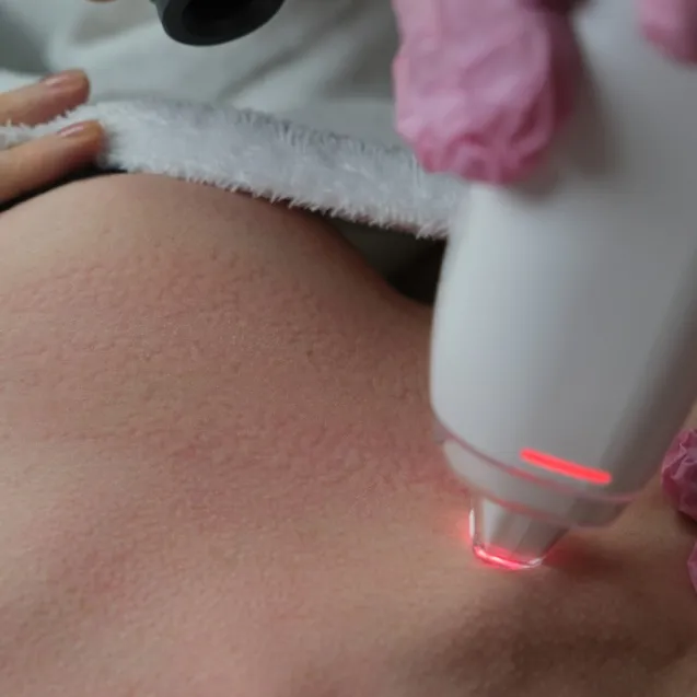 Лазерное удаление растяжек