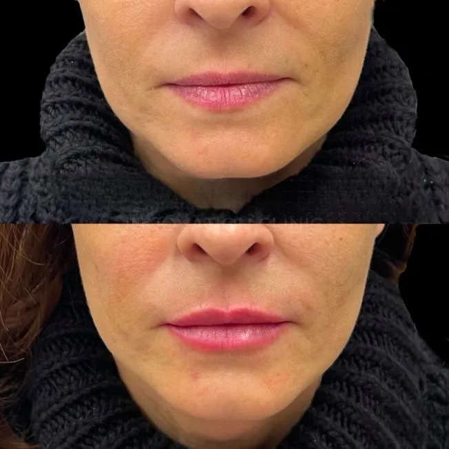 Коррекция формы губ филлером фото до и после 2