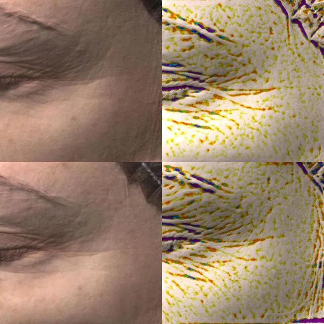 Биореструктуризация препаратом ARES Anti-Age фото до и после 4