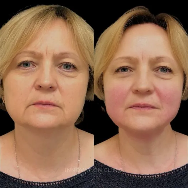 УЗ SMAS-лифтинг нижней трети лица фото до и после 4