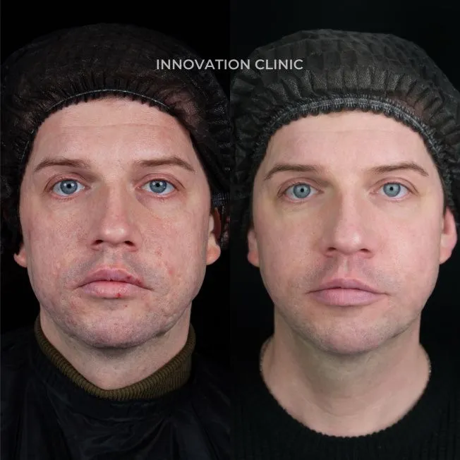 Комплексное лечение застарелых рубцов фото до и после