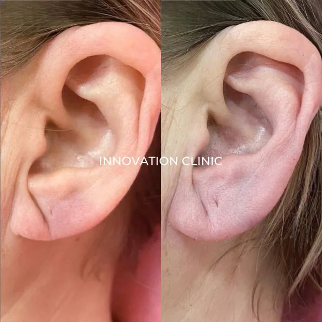 Коррекция мочки уха филлером фото до и после 4