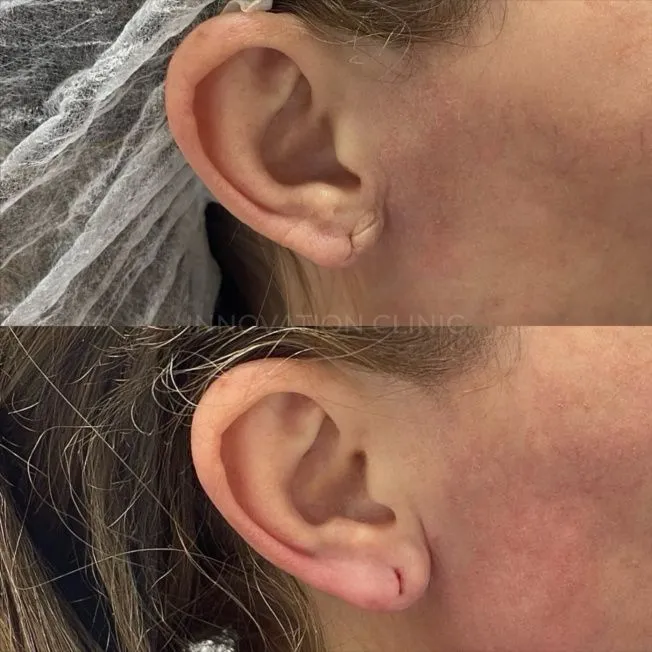 Коррекция мочки уха филлером фото до и после 3