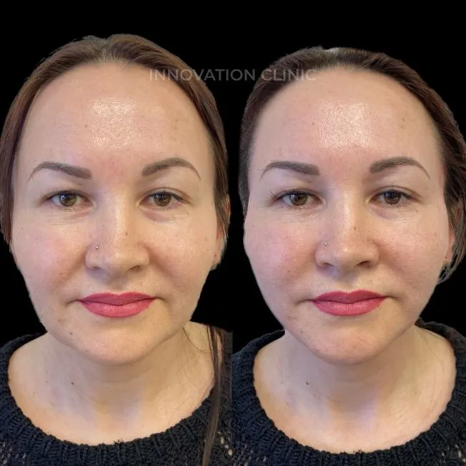 Нитевой лифтинг лица фото до и после 5