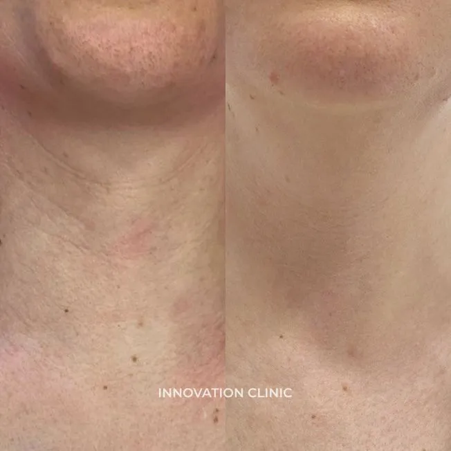 Коррекция "колец Венеры" фото до и после 1