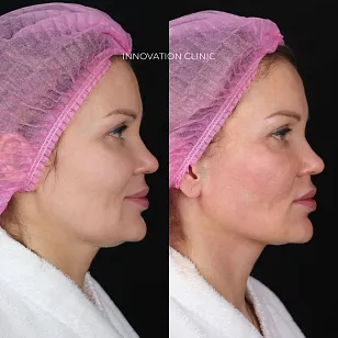 Подтяжка нитями нижней трети лица