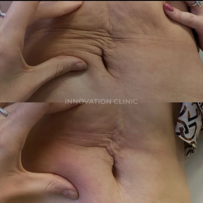 Армирование кожи живота фото до и после