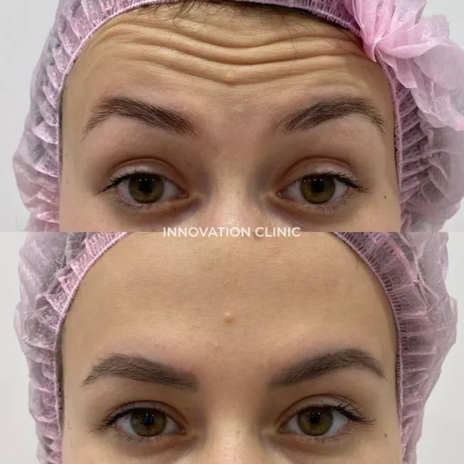 Коррекция мимических морщин лба фото до и после 6