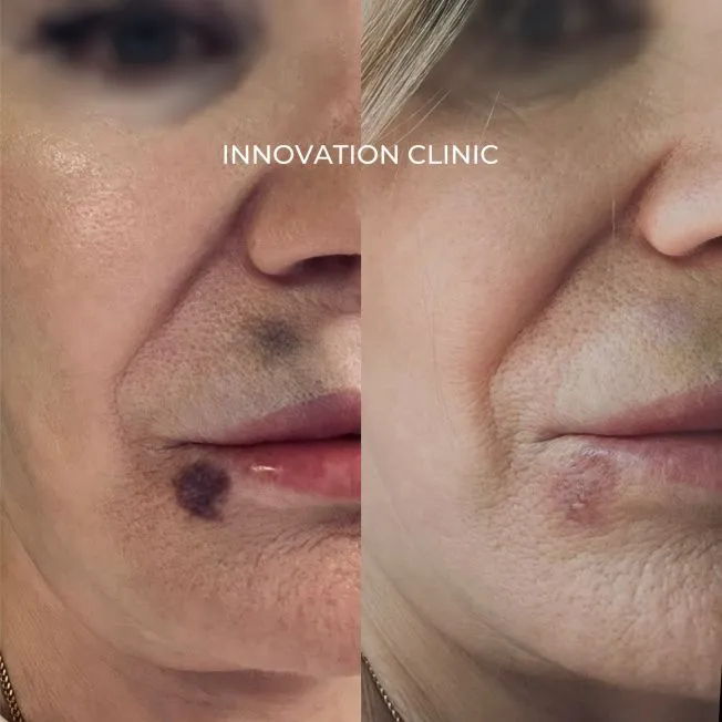 Ускорение схождения гематомы фото до и после 4