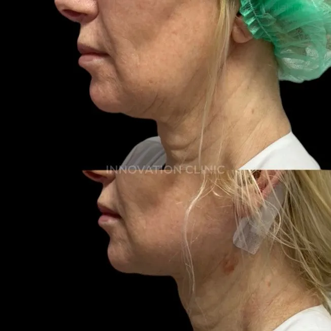 Нитевой лифтинг лица фото до и после 3