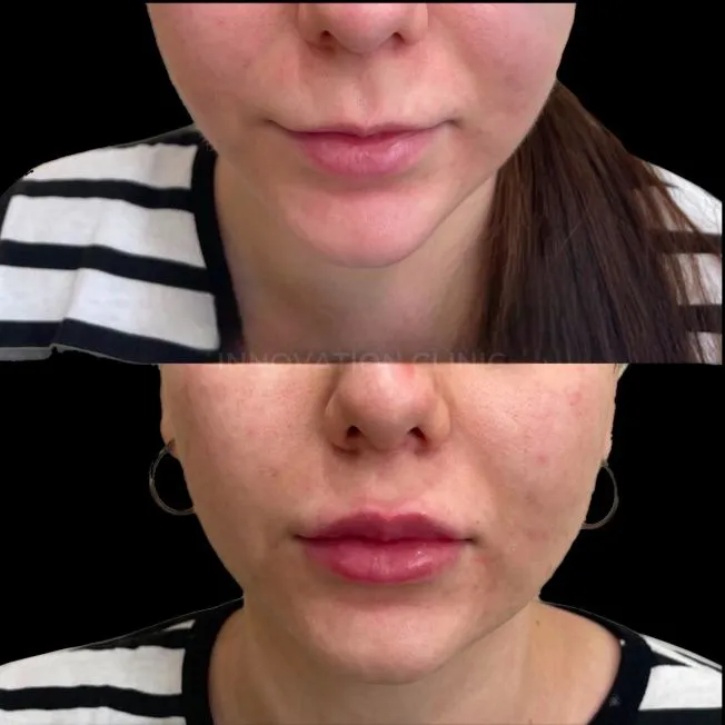 Коррекция формы губ филлером фото до и после 5