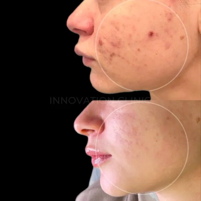 Комплексное лечение акне фото до и после 13