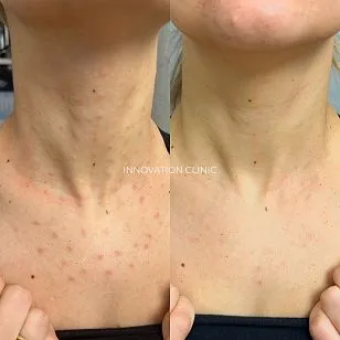 Лечение гранулемы инородного тела