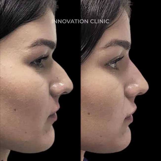 Коррекция спинки носа филлером фото до и после 3