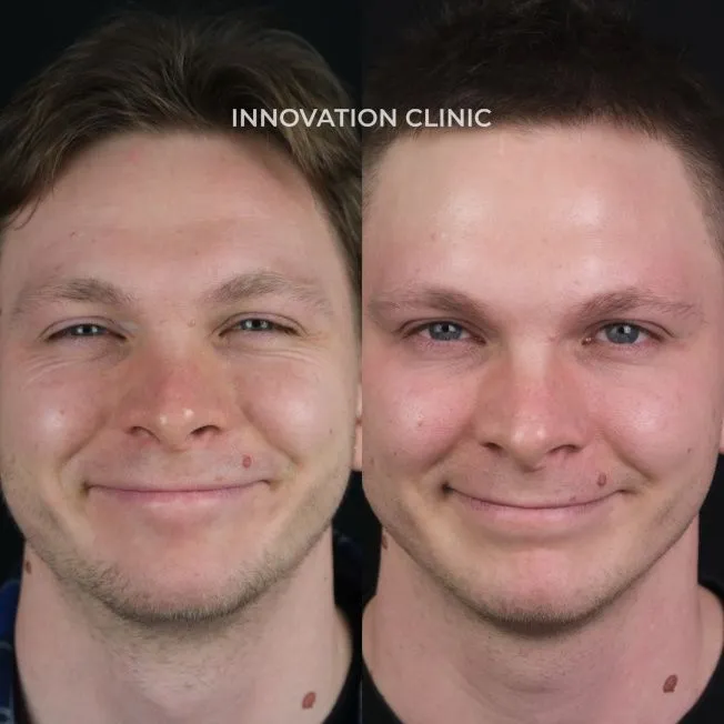 Коррекция мимических морщин лба фото до и после 8