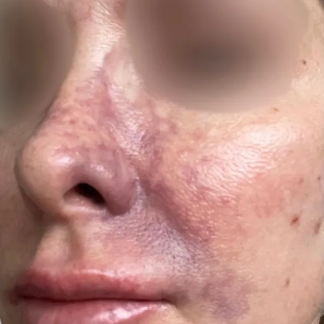 SOS-косметология (лечение осложнений)