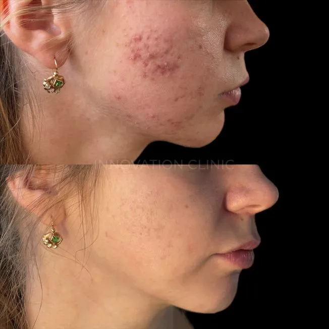 Комплексное лечение акне фото до и после 9