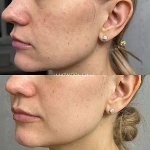 Лечение гранулемы инородного тела