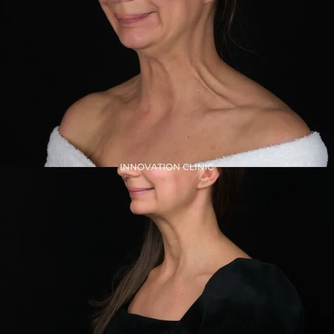 Устранение платизмарных тяжей фото до и спустя 14 дней