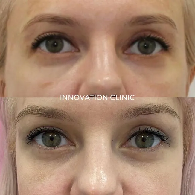 Коррекция формы верхнего века фото до и после 1