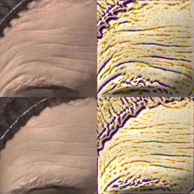 Биореструктуризация препаратом ARES Anti-Age фото до и после 3