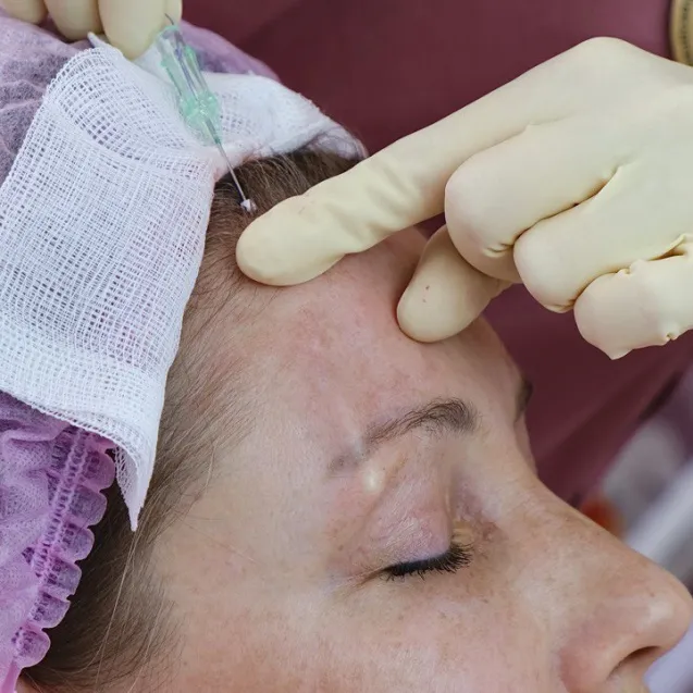 Нитевой лифтинг бровей