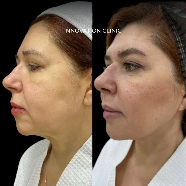 результат после протокола микроигольчатого RF-лифтинга и Smas - лифтинга